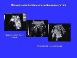 Поликистоз почек у плода во время беременности
