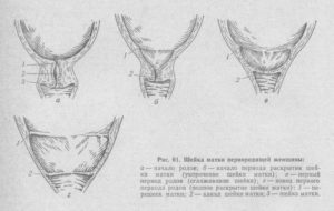 Раскрытие шейки матки на 24 неделе что делать