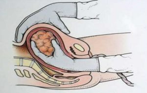 Вес плаценты при родах