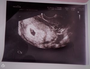 Не видно эмбриона на 6 неделе от зачатия
