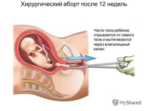 Можно ли забеременеть после чистки