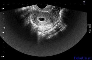 Нет эмбриона в плодном яйце 8 недель