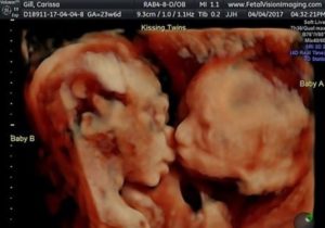 Чем отличаются близнецы от двойняшек в утробе матери