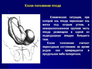 Поперечное положение плода в 32 недели форум