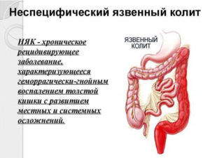 Язвенный колит кишечника у грудничка