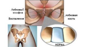 Лобковая кость болит при беременности