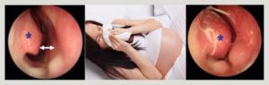 Вазомоторный ринит при беременности