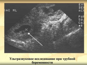 Через какое время после зачатия узи покажет беременность