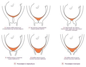 Мягкая и короткая шейка матки