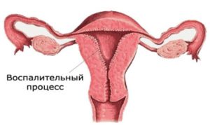 Воспаление матки после родов симптомы и лечение