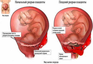 Растяжение матки при беременности