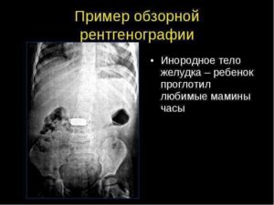 Ребенок проглотил инородный предмет симптомы