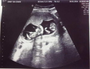 12 недель двойня беременность