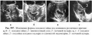 Низкое прикрепление плодного яйца на раннем сроке