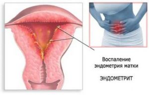 Воспаление матки после родов симптомы и лечение