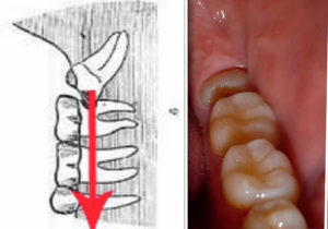 Зуб мудрости как долго растет