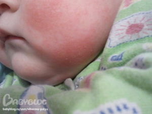 У новорожденного аллергия на порошок
