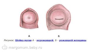 После родов матка щелевидная