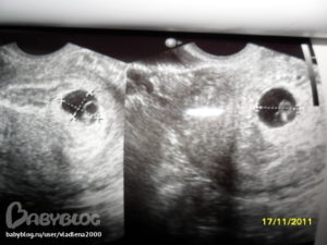 Анэмбриония и желточный мешочек