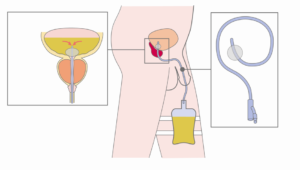 Как правильно носить катетер фолея