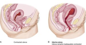 Матка после кесарева плохо сокращается матка что делать