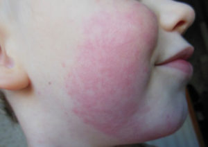 Аллергия на кондиционер у ребенка