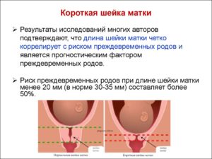 Мягкая и короткая шейка матки