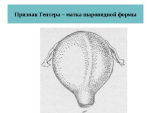 При беременности матка шаровидная