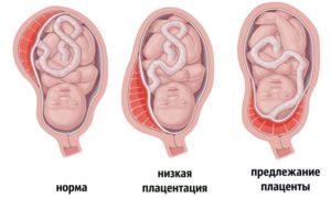 Низкая плацентация при беременности 21 неделя что делать