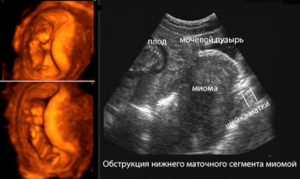 Можно ли спутать беременность с миомой на узи