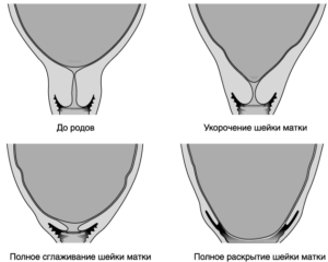 Раскрытие шейки матки на 4 пальца когда рожать