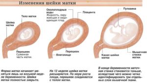 Матка слева при беременности