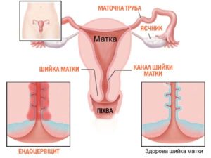 Две шейки матки у женщин