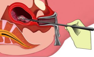 Выскабливание матки после родов последствия