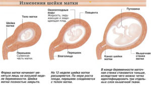 Беременность низко шейка матки