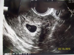 На 6 неделе беременности мажет