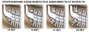 Зуб мудрости в 15 лет