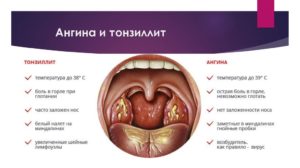 Болит горло и 37 температура при беременности