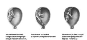 Отслойка плаценты и гематома на ранних сроках беременности