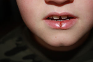 Ребенок порвал губу что делать