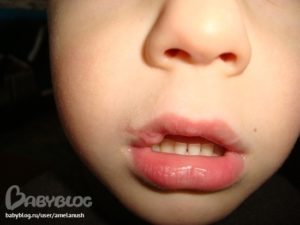 Ребенок порвал губу что делать