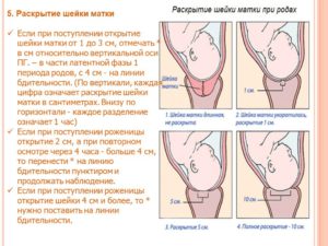 Раскрытие шейки матки на 3 пальца когда роды