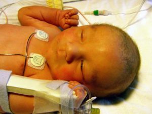 Желтушка у новорожденных опасна ли