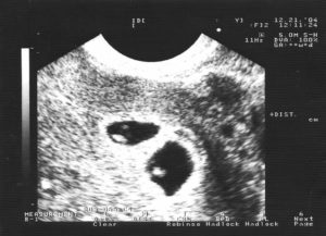 Двойня 6 недель беременности