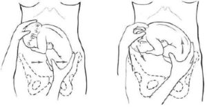 Упражнения для поворота плода в головное предлежание