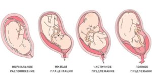 Плацента расположена по задней стенке матки низко расположена