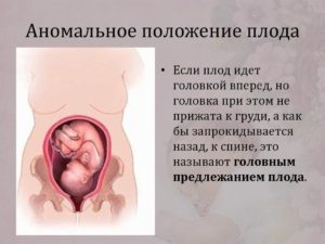 Поперечное положение плода на 33 неделе беременности
