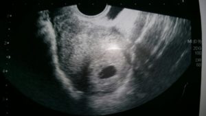 Не видно эмбриона на 6 неделе от зачатия