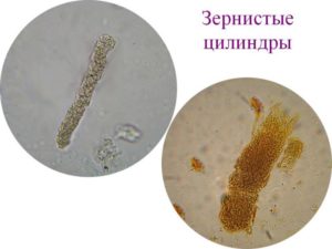 В моче цилиндры зернистые