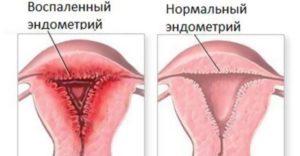 Размер эндометрия после выкидыша